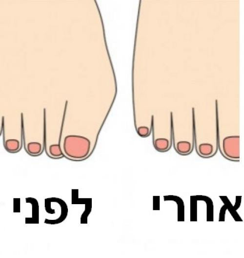 2 יחידות גרב שרוול לכף הרגל המסייע בשחרור לחצים וכאבים חדים מאיזור הבוניון !